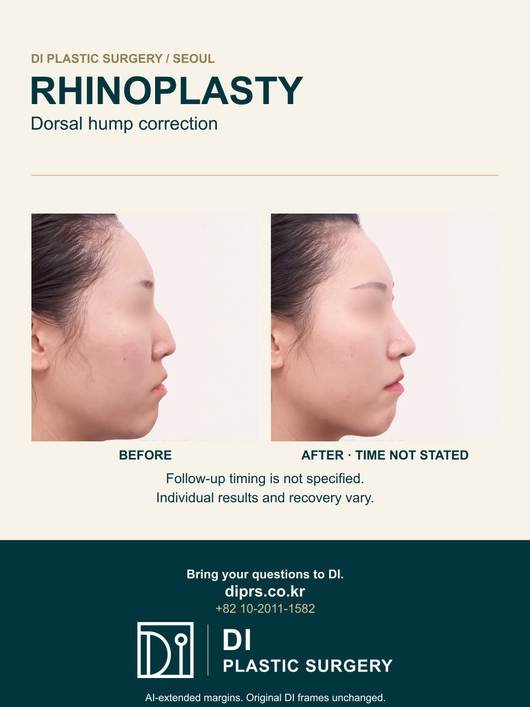 Original DI before-and-after rhinoplasty frames with eye masking and clinical contours preserved; AI-extended outer margins, follow-up timing disclaimer and DI logo.