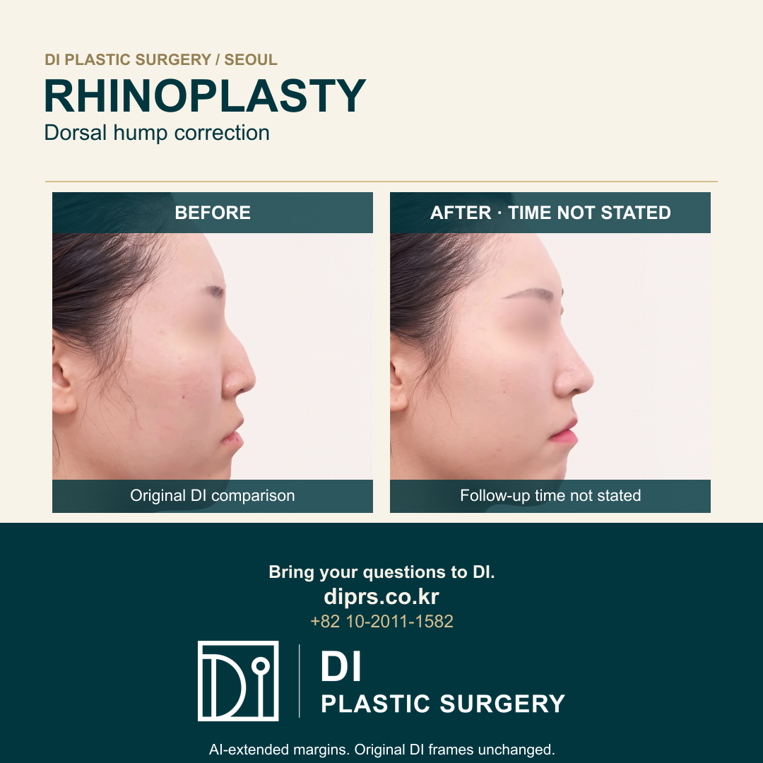 Original DI before-and-after rhinoplasty frames, with eye masking and clinical contours preserved; AI-extended outer margins, English follow-up timing disclaimer and DI logo.