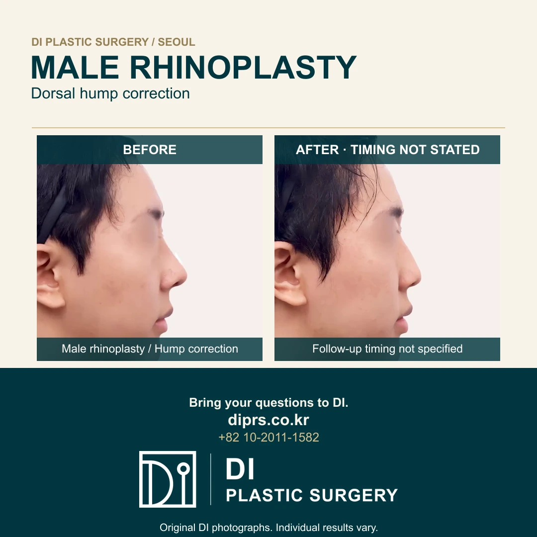 Male Rhinoplasty with Dorsal Hump Correction: Original DI Case Reel