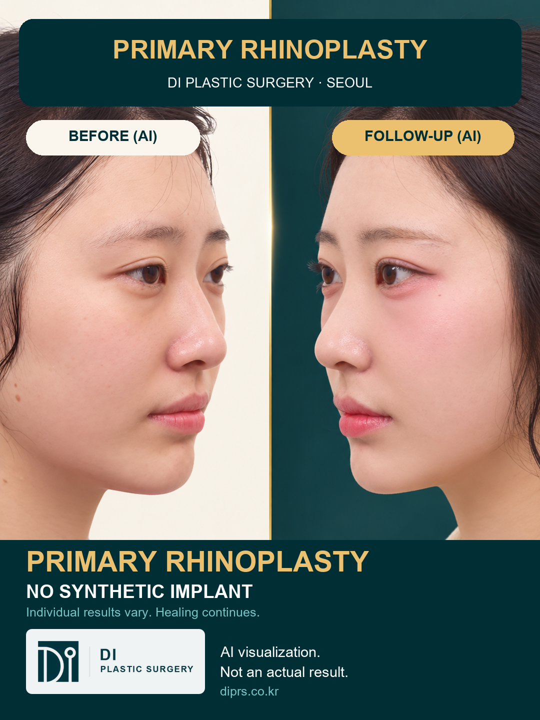 Primary Rhinoplasty Without a Synthetic Implant: DI English Case Reel