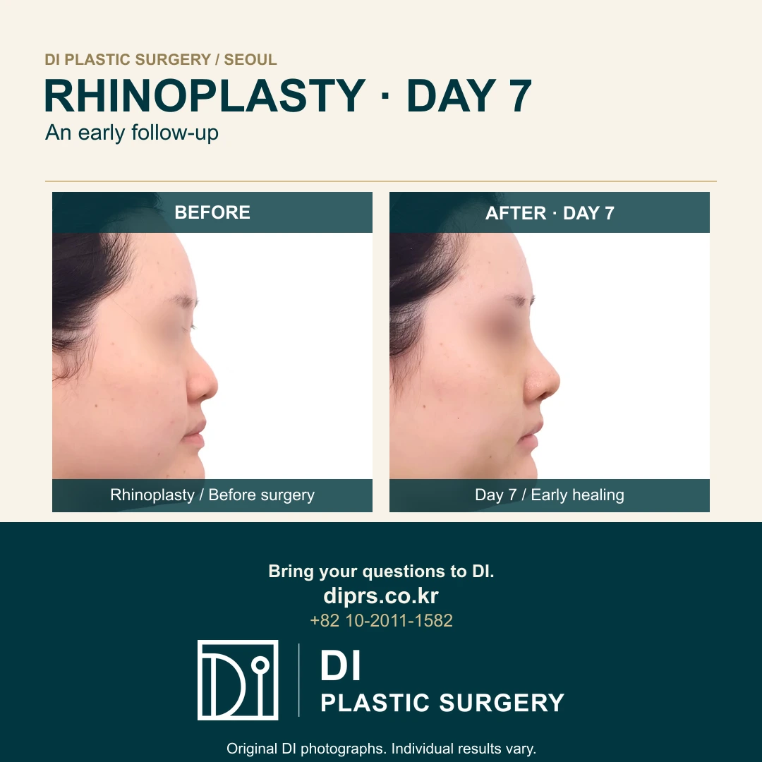 Rhinoplasty: Before Surgery and Day-Seven Follow-Up
