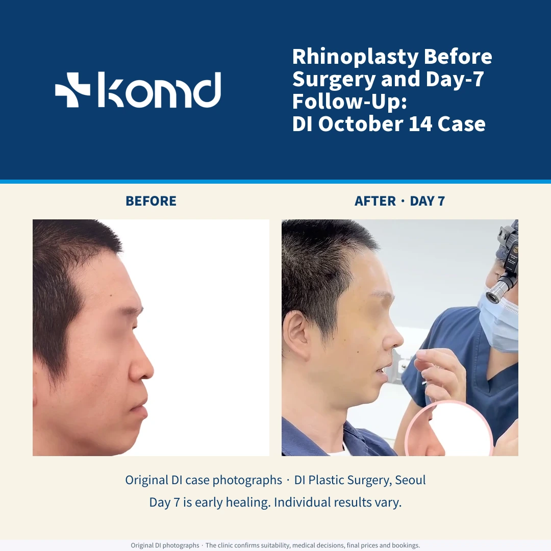 DI October 14 rhinoplasty case: original same-case before-surgery and early day-seven photographs. Existing privacy masking preserved; day seven is not the final result.