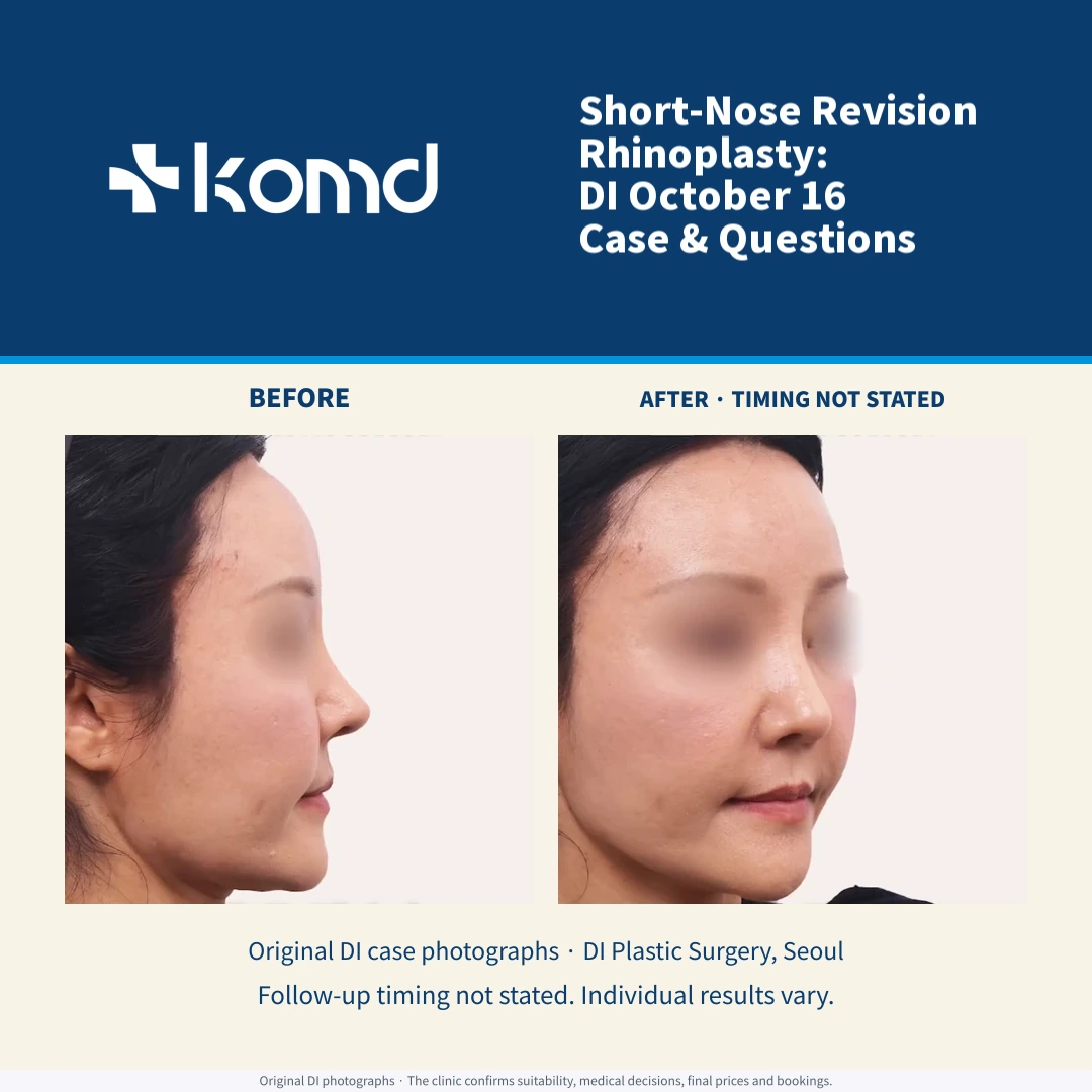 DI October 16 short-nose revision case: original same-case before and after photographs. Existing privacy masking preserved; follow-up timing is not stated.