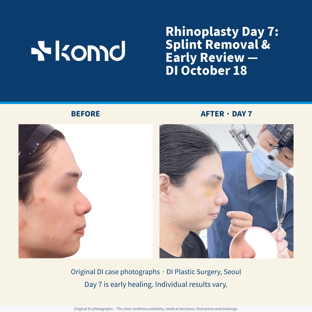DI October 18 rhinoplasty case: original same-case before-surgery and early day-seven photographs. Existing privacy masking preserved; early healing is not the final result.